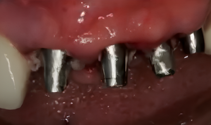 Abutments For A Cement-Retained Restoration After Immediate Implant Placement Youtube / Dr. Kamil Khabiev / Dental Guru Academy Abutments for a cement-retained restoration after immediate implant placement youtube / dr. Kamil khabiev / dental guru academy