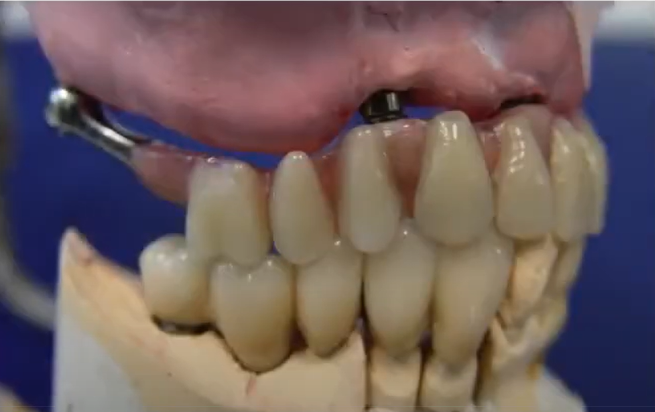 An Example Of A Poorly Designed Removable Prosthesis, Likely Created To Avoid A Sinus Lift Procedure Youtube / Dr. Kamil Khabiev / Dental Guru Academy An example of a poorly designed removable prosthesis, likely created to avoid a sinus lift procedure youtube / dr. Kamil khabiev / dental guru academy