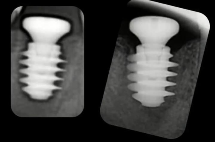 An Implant With Aggressive Threads: Immediately After Placement In An Extraction Socket (Left) And After Osseointegration (Right) Youtube / Dr. Kamil Khabiev / Dental Guru Academy An implant with aggressive threads: immediately after placement in an extraction socket (left) and after osseointegration (right) youtube / dr. Kamil khabiev / dental guru academy