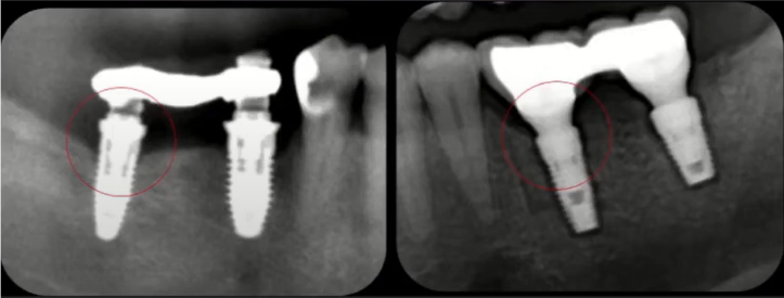 Consequences Of No Platform Switching (Left): Significant Bone Loss. With Platform Switching (Right), Bone Levels Are Stable Youtube / Dr. Kamil Khabiev / Dental Guru Academy Consequences of no platform switching (left): significant bone loss. With platform switching (right), bone levels are stable youtube / dr. Kamil khabiev / dental guru academy