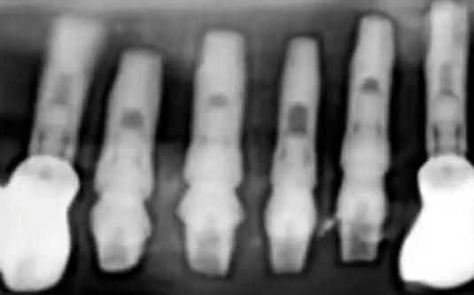 Four Implants Placed Immediately After Hopeless Teeth Extraction Youtube / Dr. Kamil Khabiev / Dental Guru Academy Four implants placed immediately after hopeless teeth extraction youtube / dr. Kamil khabiev / dental guru academy