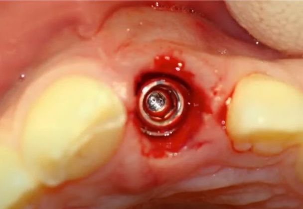 Immediate Implant Placement After Tooth Root Extraction, Observing The Biological Width Principle Youtube / Dr. Kamil Khabiev / Dental Guru Academy Immediate implant placement after tooth root extraction, observing the biological width principle youtube / dr. Kamil khabiev / dental guru academy