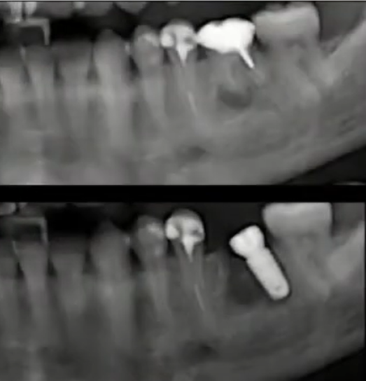 Implant Placed In The Distal Root Socket, Resulting In A Noticeable Angulation Youtube / Dr. Kamil Khabiev / Dental Guru Academy Implant placed in the distal root socket, resulting in a noticeable angulation youtube / dr. Kamil khabiev / dental guru academy