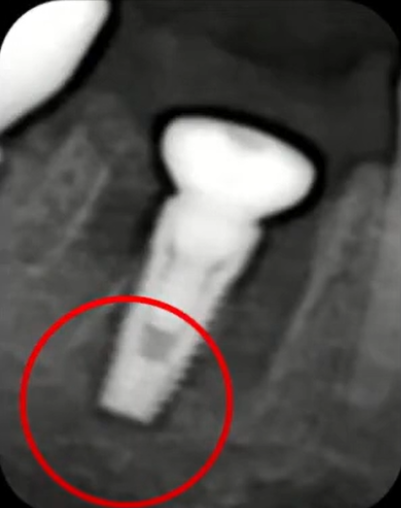 Implant Placed In The Interradicular Septum, With Stability Achieved Through Apical Fixation Youtube / Dr. Kamil Khabiev / Dental Guru Academy Implant placed in the interradicular septum, with stability achieved through apical fixation youtube / dr. Kamil khabiev / dental guru academy