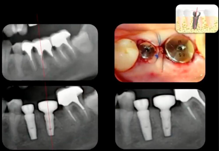 Implants Placed Immediately After Extraction. The Molar Implant Was Placed In The Mesial Root Socket, Not The Interradicular Septum Youtube / Dr. Kamil Khabiev / Dental Guru Academy Implants placed immediately after extraction. The molar implant was placed in the mesial root socket, not the interradicular septum youtube / dr. Kamil khabiev / dental guru academy