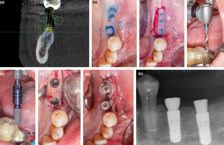 Comparison of the accuracy of implant placement using CAD/CAM-manufactured surgical templates and traditional methods