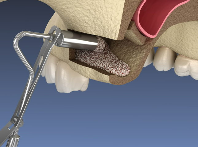Introduction Of Osteoplastic Material During Open Sinus Lift Surgery Youtube / Dr. Kamil Khabiev / Dental Guru Academy Introduction of osteoplastic material during open sinus lift surgery youtube / dr. Kamil khabiev / dental guru academy