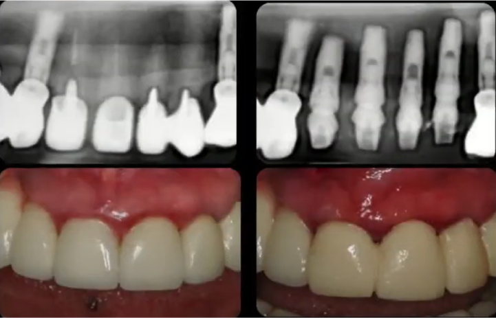 Radiographic And Clinical Views Before And After Implant Placement Youtube / Dr. Kamil Khabiev / Dental Guru Academy Radiographic and clinical views before and after implant placement youtube / dr. Kamil khabiev / dental guru academy