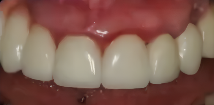 Soft Tissue Inflammation Around A Prosthesis In The Anterior Maxilla Youtube / Dr. Kamil Khabiev / Dental Guru Academy Soft tissue inflammation around a prosthesis in the anterior maxilla youtube / dr. Kamil khabiev / dental guru academy