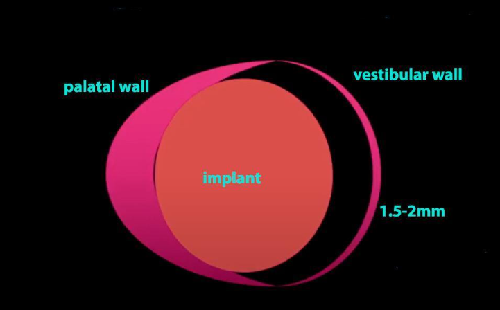 The Principle Of Maintaining Biological Width During Immediate Implant Placement Youtube / Dr. Kamil Khabiev / Dental Guru Academy The principle of maintaining biological width during immediate implant placement youtube / dr. Kamil khabiev / dental guru academy