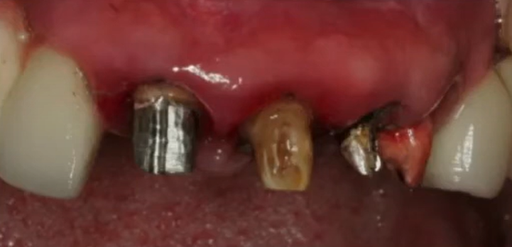 The Remains Of Destroyed Teeth, Some Under Silver Inlays. The Remains Of Teeth Are Hopeless And Subject To Extraction Youtube / Dr. Kamil Khabiev / Dental Guru Academy The remains of destroyed teeth, some under silver inlays. The remains of teeth are hopeless and subject to extraction youtube / dr. Kamil khabiev / dental guru academy