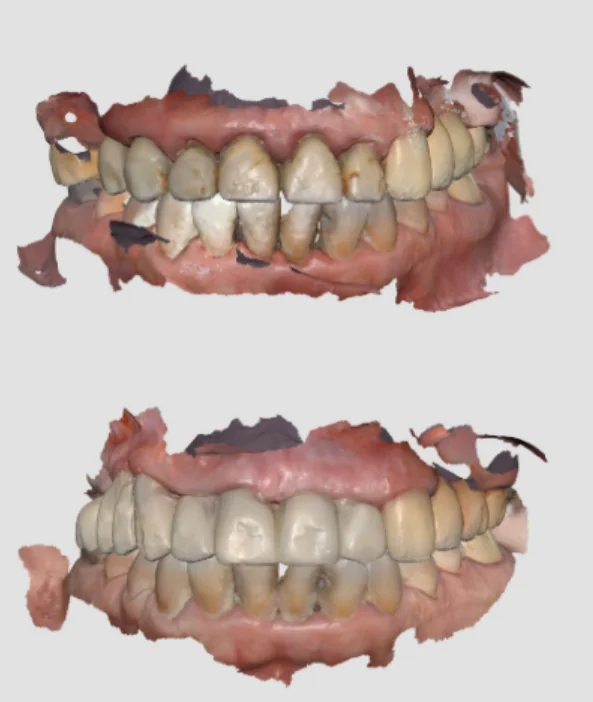 Scanned images of the initial state of the teeth and bridge