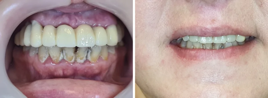 Permanent bridge with good gingival fit