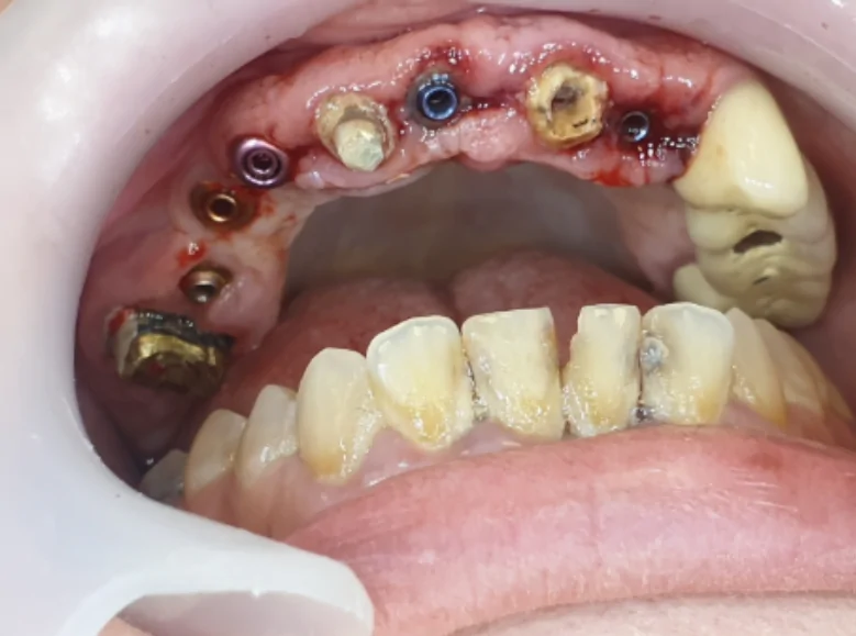 The condition of the teeth and implants after removing the temporary bridge