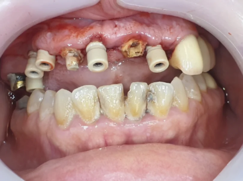 Installed scan abutments to remove digital casting jaw