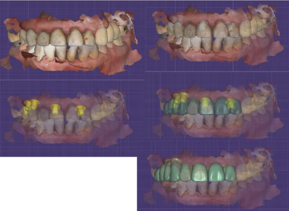 Digital imaging of the jaws and design of the new zirconia bridge