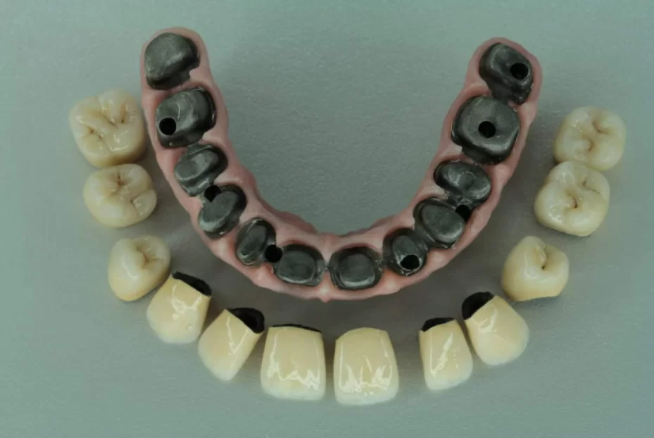 Metal-ceramic prosthesis - base with screw channels and porcelain crowns