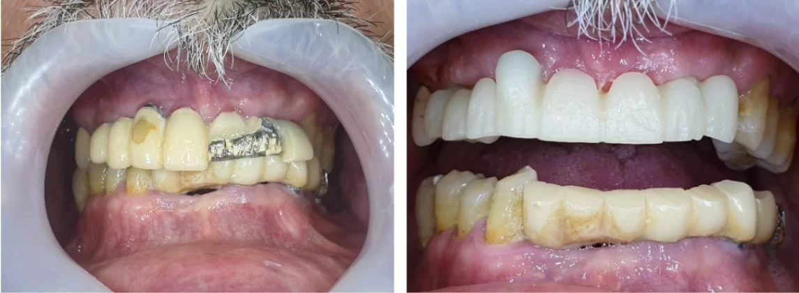 The problem with which the patient came (left photo) and a new zirconia prosthesis (right photo)