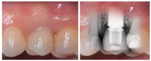 The implant's precise location is difficult to discern due to the presence of a wide and well-developed keratinized gingiva.