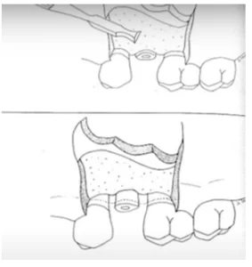 Recommendation for dentists to create a soft-tissue connection by freeing up space (2. 7-3 mm) and removing part of the alveolar ridge to accommodate the biological width in clinical indications.