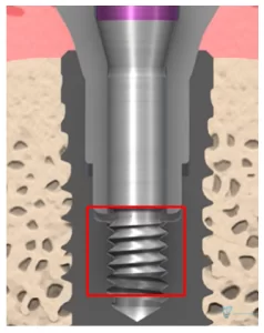 Fractures predominantly located in the lower part of the screw, as denoted by the red rectangle.