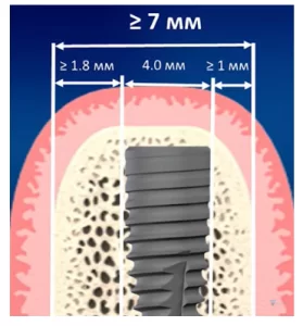Optimal alveolar bone width and how to reduce risk of dental implant and abutment fracture