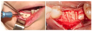 Bone grafting to compensate for the bone deficiency in the horizontal area