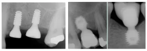 Short dental implants placed subcrestally so entire implant body has dense bone support as 0. 8-1. 2mm bone loss occurs in a year.