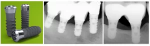 Transgingival implant design reaching the margin is a solution to avoid subcrestal bone loss with short dental implants.