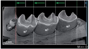 Why gaps appear between teeth and implants screenshot 73