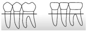 Why gaps appear between teeth and implants screenshot 76