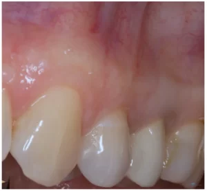 Healthy mouth with a wide, slightly whitish keratinized gum that is visually distinct from the pink mobile mucosa above.