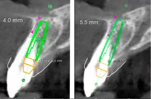 The loaded 4mm portion is only one-third of the 12mm implant, insufficient for load bearing compared to the better ratio in the second image.