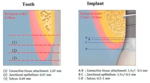 Implant with a neck height of 2. 8 mm, allowing for the formation of a complete complex of soft-tissue attachment, including connective tissue attachment, epithelial attachment, and sulcus