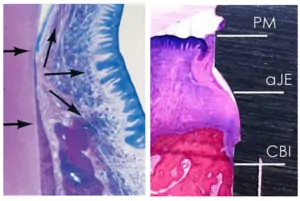 The process of epithelium overgrowth and a healthy soft tissue reaction to penetration, functioning as a "conductor" for the growth.
