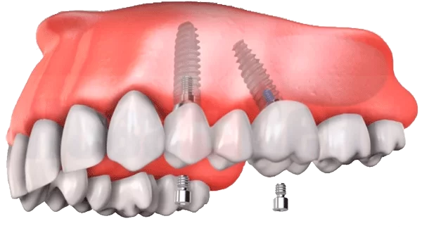 Dental implant placement at an angle to bypass the internal cavities of the skull