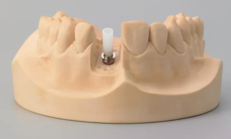 Standard angled abutment versus cast custom abutment on a model demonstrating different manufacturing processes. Part 2