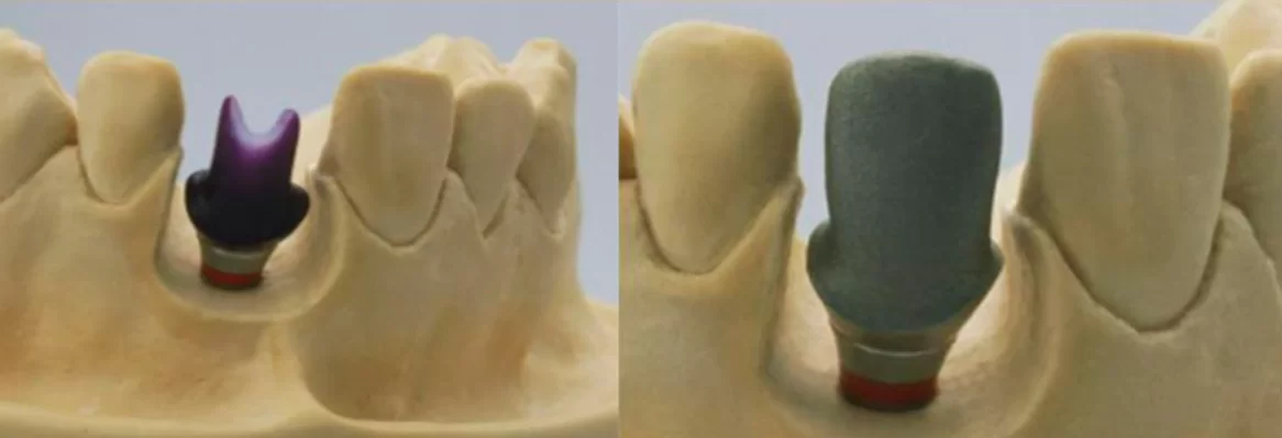 Standard angled abutment versus cast custom abutment on a model demonstrating different manufacturing processes. Part 3