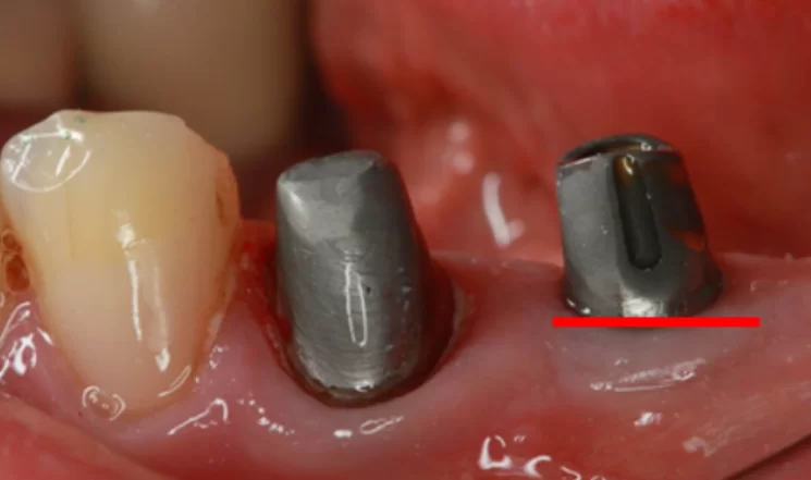 Standard dental abutments with straight and angled options finalized by a technician to create prosthesis bases, with the subgingival portion untouched.