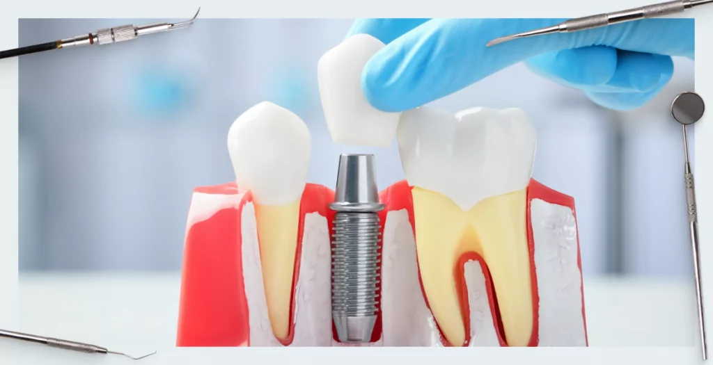 Individual and standard abutments – features and benefits