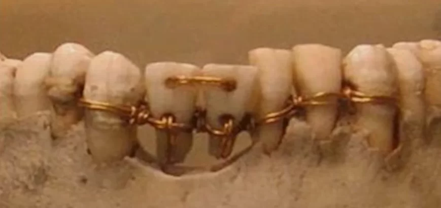Restoration of the dentition with the patient's teeth using gold wire. Ancient egypt around 2500 bc