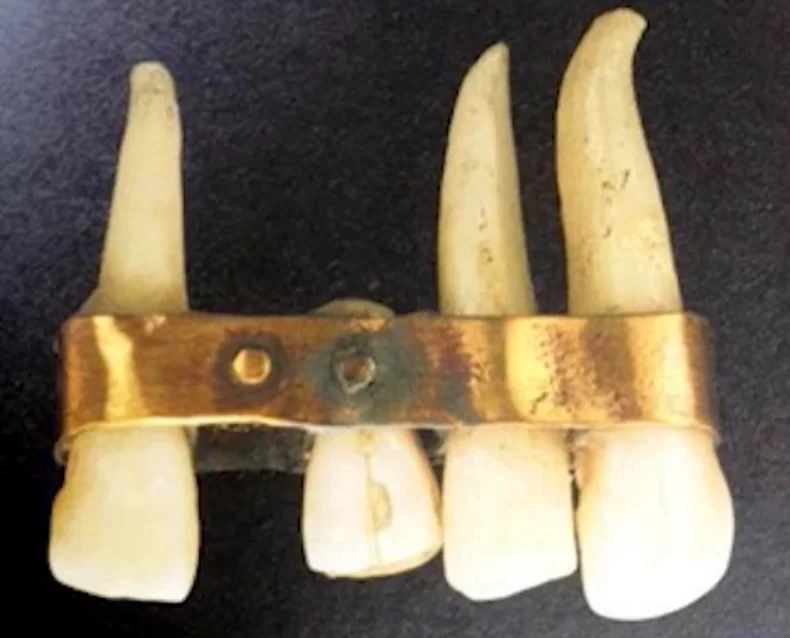 Restoration of the dentition in gold ligature - etruscan culture 5th century bc