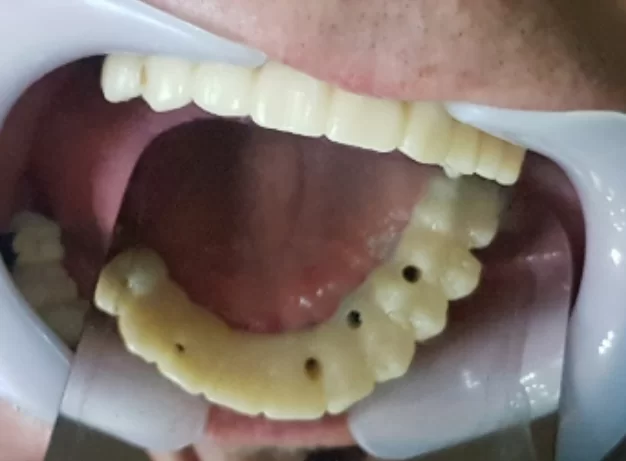 Prosthesis in the patient's mouth