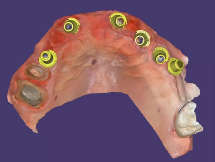 Computer model with the location of implants and abutments with sleeves