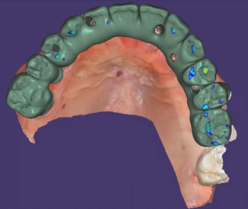 Computer model of the patient's jaw with the prosthesis