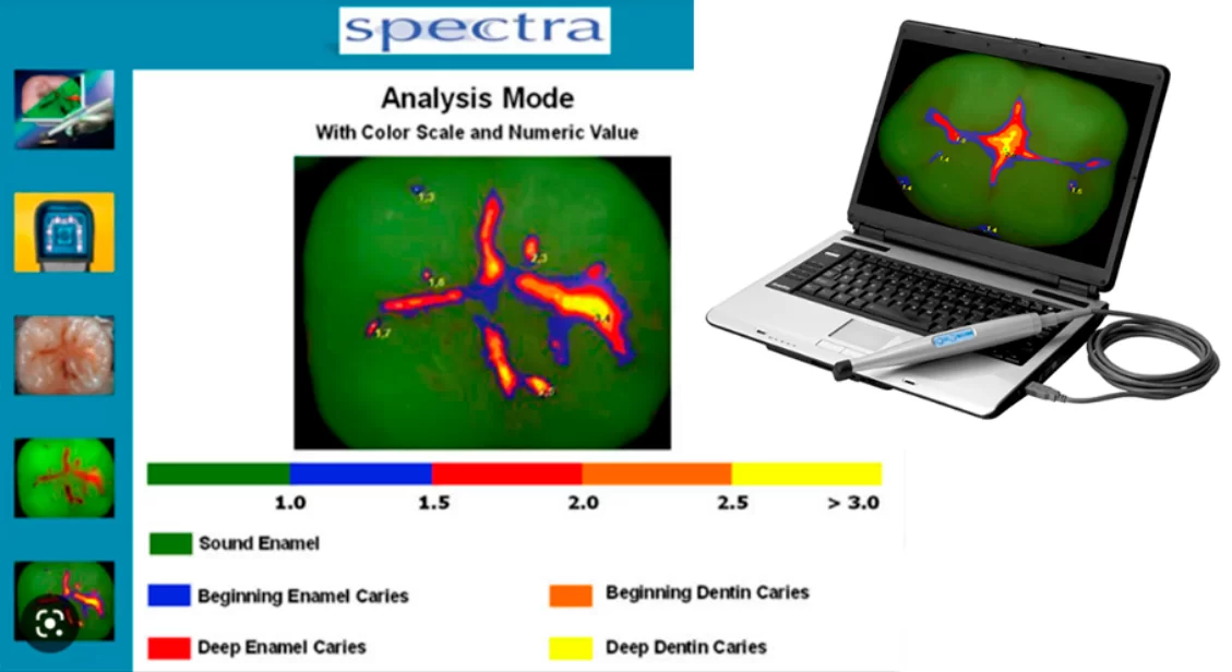 Now caries can be found earlier, the new technology is the optical scanner “Spectra”