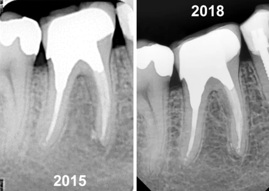 Permanent crown placed in 2015 with good outcomes at 3-year follow-up in 2018 image.