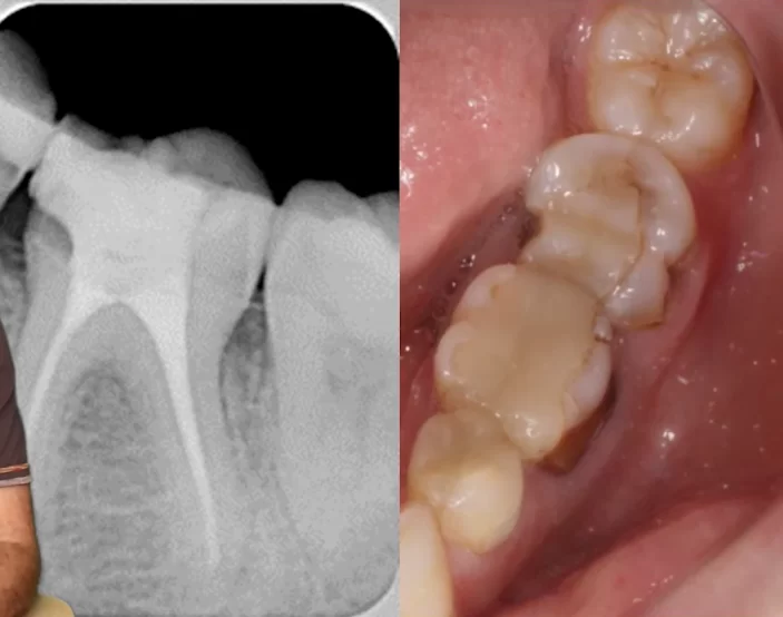Image shows poorly contoured amalgam restoration with open margins on two teeth.