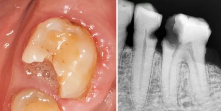 Without a protective crown, tooth fracture risk increases.