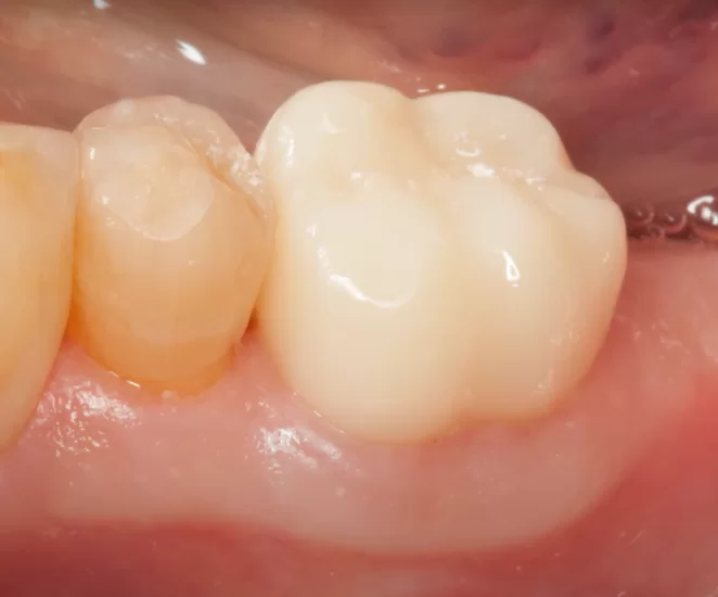 Severely compromised endodontically treated teeth require crown completion to protect the remaining tooth structure.